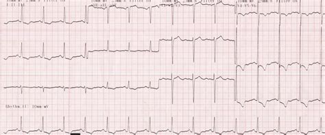 lvh with strain pattern meaning